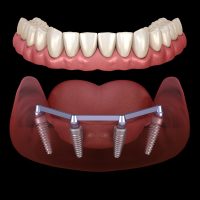 Implant Dentures in Willimantic