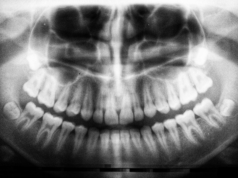 Digital X-Rays in Willimantic