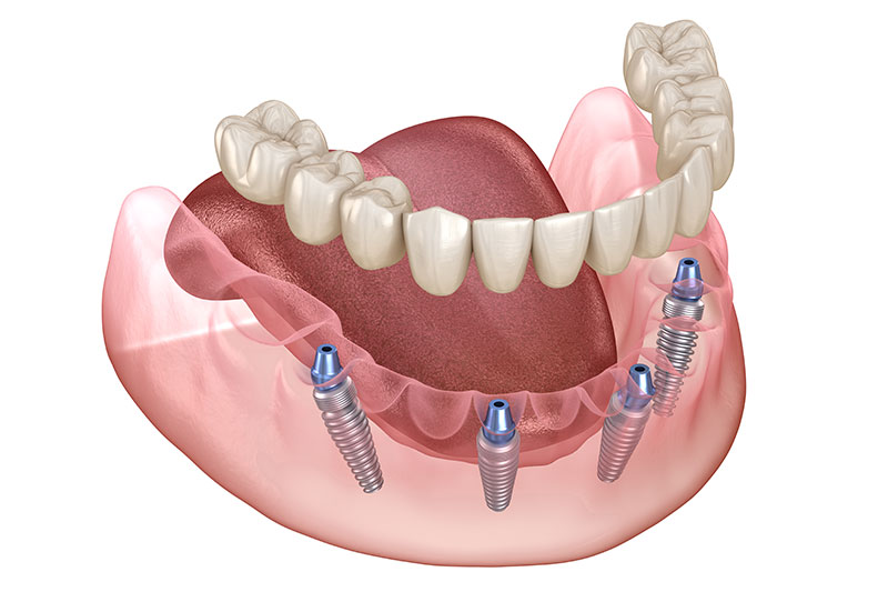 All On 4/6 Dental Implants in Willimantic