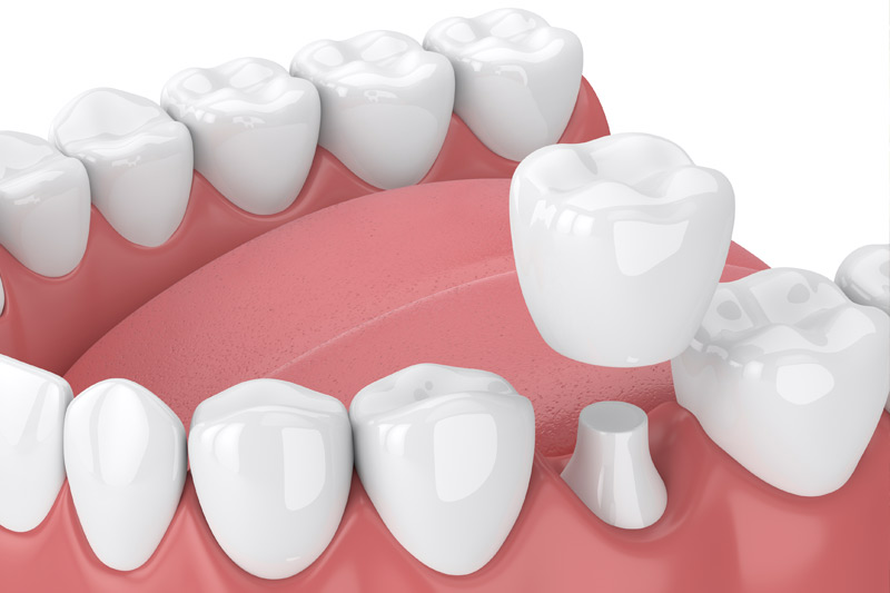 Dental Crowns in Willimantic