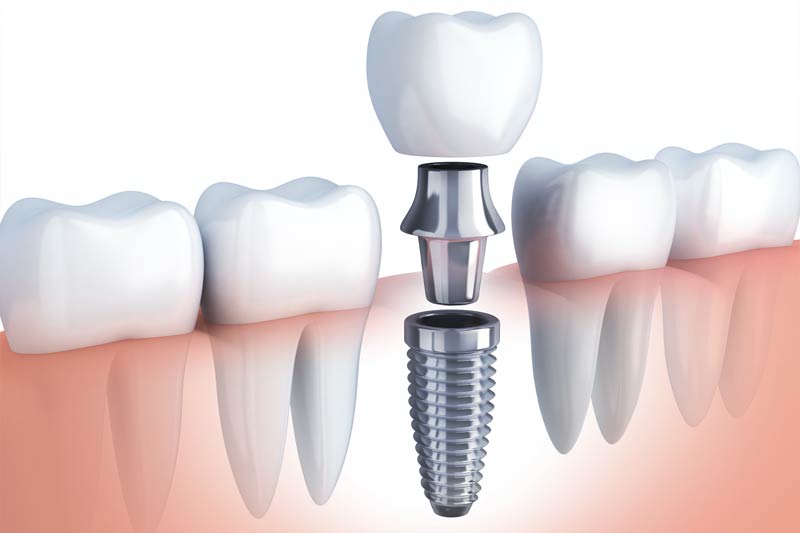 Riverview Dental Special Offer