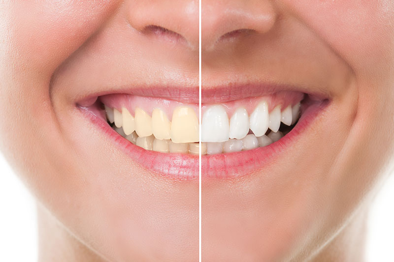 Teeth Whitening in Willimantic