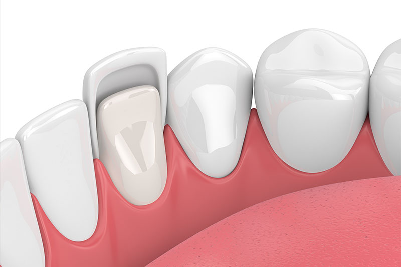 Porcelain Veneers in Willimantic